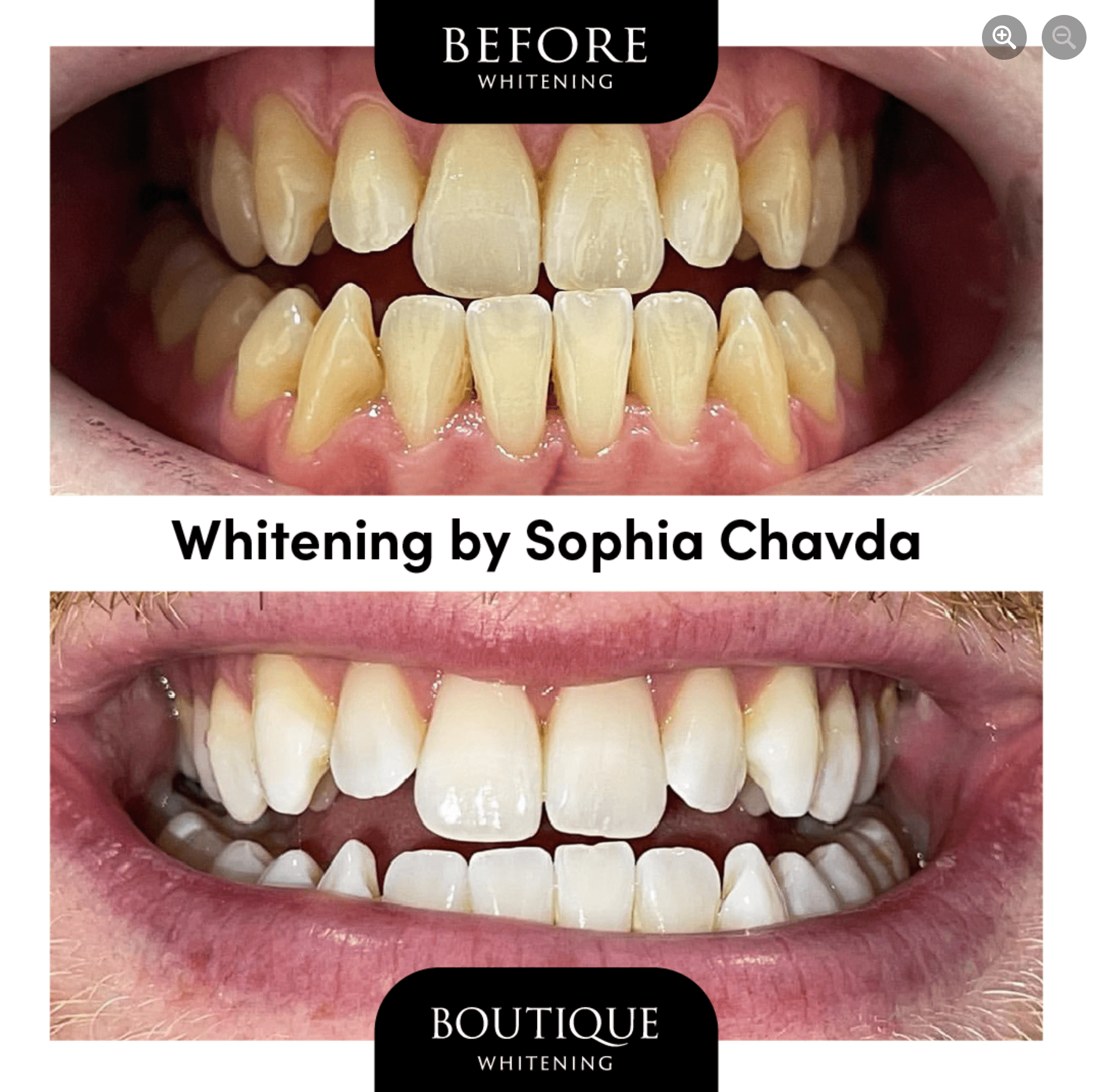 Teeth Whitening By Dr Sophia Chavda
